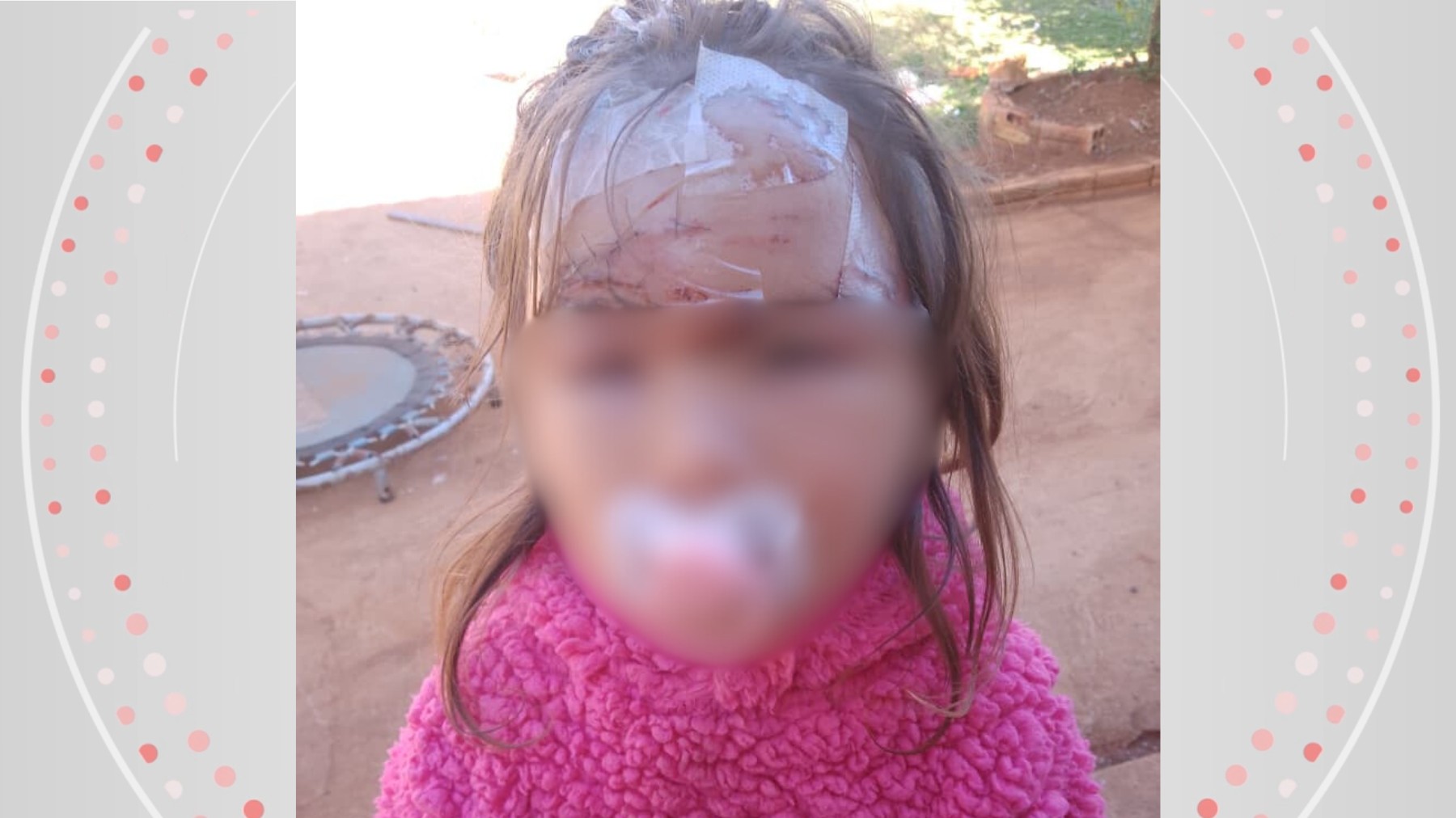 Criança de 3 anos leva 27 pontos no rosto após ser atacada por cachorro no dia do aniversário, no Paraná